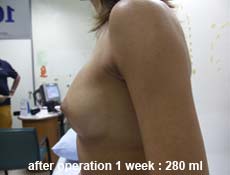 plastic-surgery-breast-augmentation 